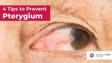 Prevent pterygium article header